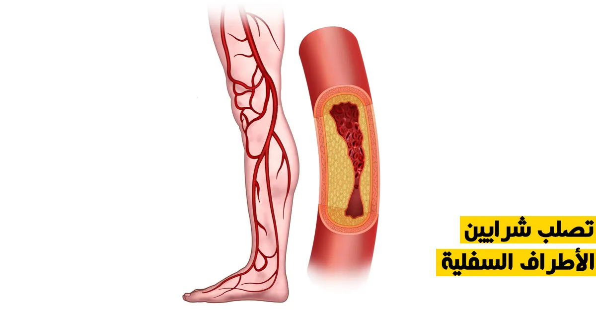 تصلب شرايين الأطراف السفلية